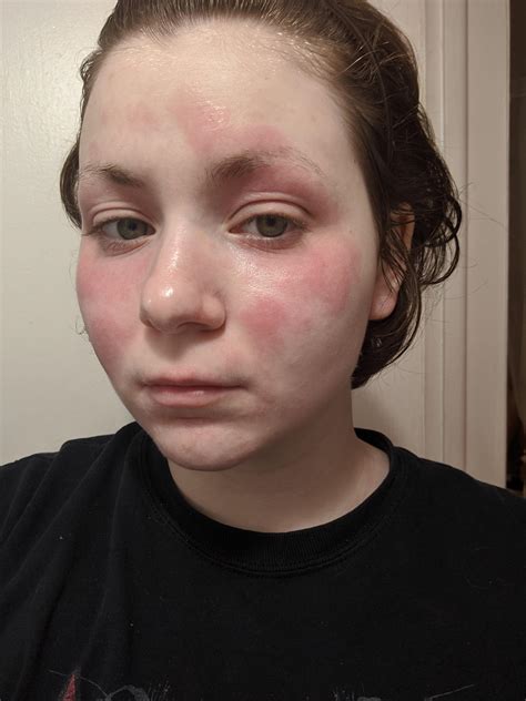 itchy flakey red rash spreading  face   june