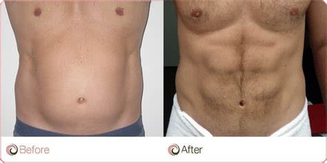 types  liposuction cost weight loss surgery