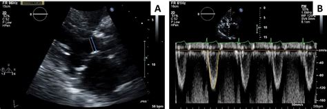 Take Home Messages With Cases From Focused Update On Echocardiographic