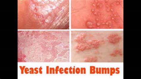 Extraordinary Truths Yeast Infection