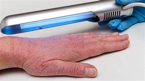 the pros and cons of eczema light therapy everyday health