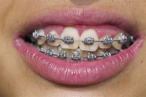 inspirasi terpopuler teeth with braces trend terbaru