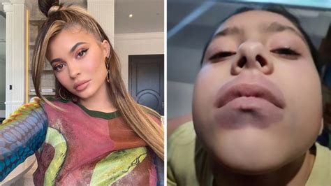 kylie jenner lip challenge leads to girl s shock diagnosis 7news