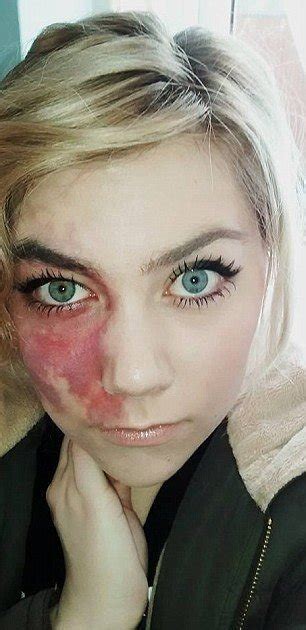 woman with facial birthmark was told she was too ugly for