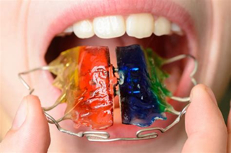 treatments   braces plates  aligners orthodontics