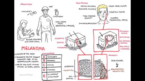 Melanoma Overview Signs And Symptoms Pathology Risk Factors