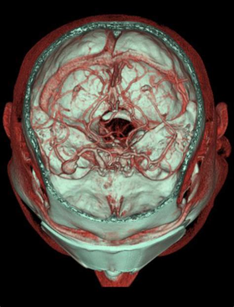 aneurysma im bereich der trifurcation der arteria cerebri media ct