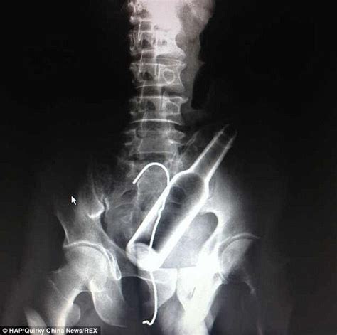X Rays Show Bottle Stuck In Man S Rear And A Hooked Wire Daily