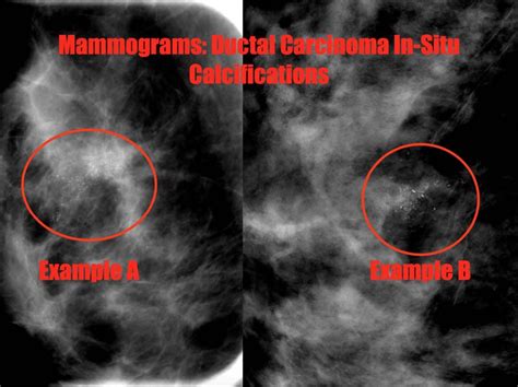 Ductal Carcinoma In Situ Dcis On Breast Imaging – The