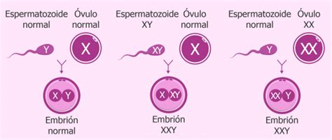 Síndrome De Klinefelter 47 Xxy Causas Características Y Síntomas