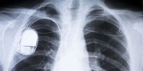 hackers  access pacemakers  dont panic   fox news