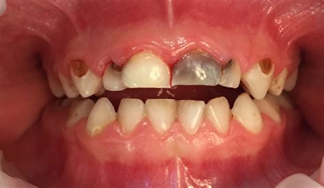 faq    child  cavities shelby pediatric dentistry