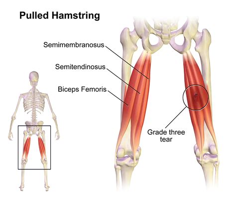 sports  fitness injury pulled hamstring health life media
