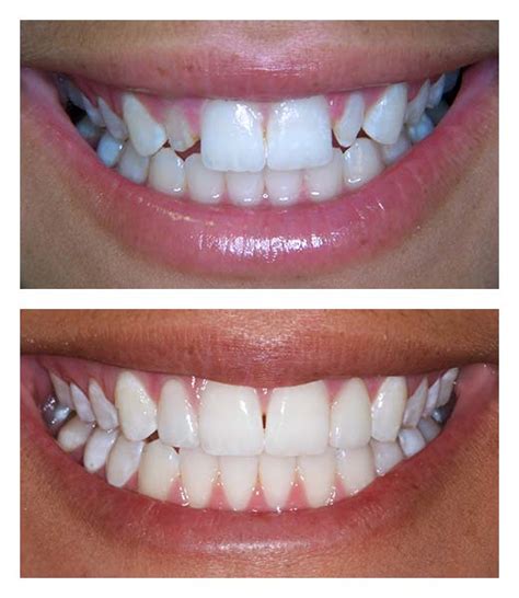 Dental Veneers Before And After Bartholomew Dentist