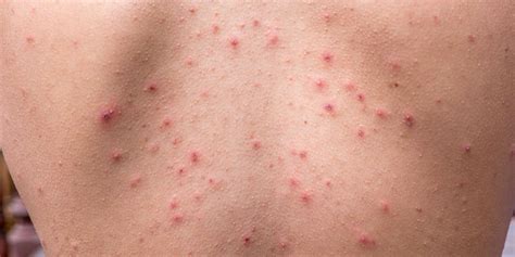 How To Get Rid Of Bacne For Good Best Back Acne Products And Treatments