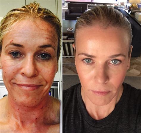 Chelsea Handler Looks Half Her Damn Age After Laser Facial See The