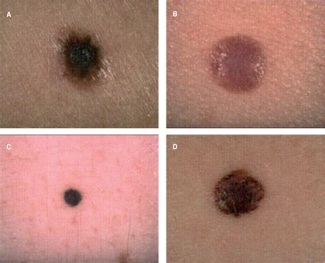 melanoma malignant melanoma nodular type  hand photograph  learn  melanoma