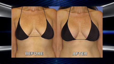 woman s weight loss makeover is completed with breast lift