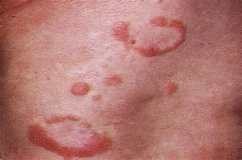 Dermatitis Infecciones Micoticas De La Piel