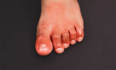 painful red inflammation  toe called covid toe lesions strange sign
