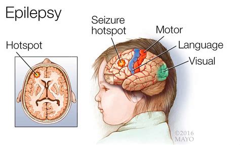 seizure disorders epilepsy nursing care management nurseslabs