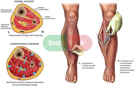 compartment syndrome with fasciotomy surgery doctor stock