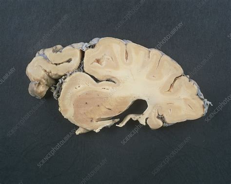 view   slice   healthy human brain stock image p