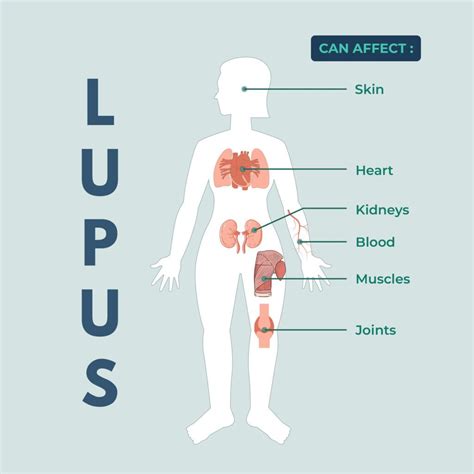 lupus hereditary  overview  genetic factors xcode life
