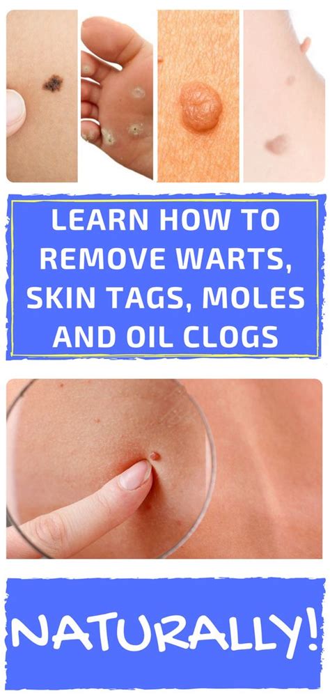 learn how to remove warts skin tags moles and oil clogs