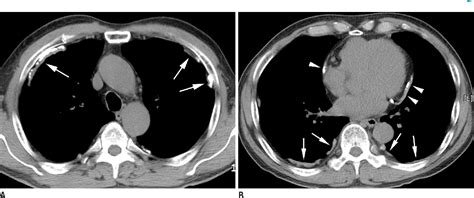 Figure 2 From Ct Characteristics Of Pleural Plaques Related To
