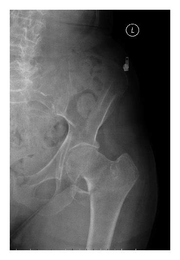 outcomes  geriatric hip fractures treated  affixus hip fracture nail