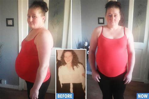 scots mum left with a bulging belly caused by a bowel blockage can t