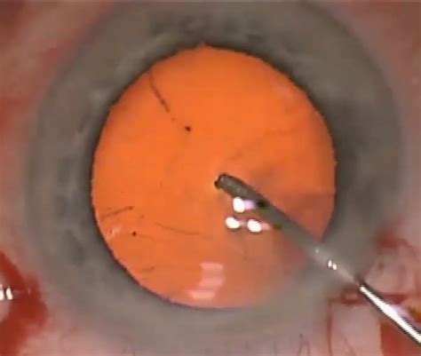 lecture cataract surgery  difficult eyes cybersight