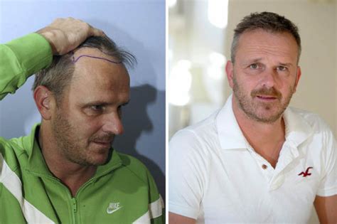 Didi Hamann Gets Hair Transplant To Look Its Best For Tv Show Daily Star
