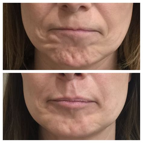 botox injections in the chin clinetix clinetix