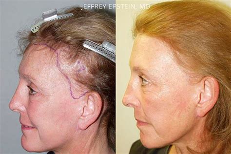 facelift scar repair miami repair facelift scarring hair restoration