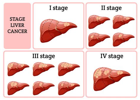types  liver cancer     develop