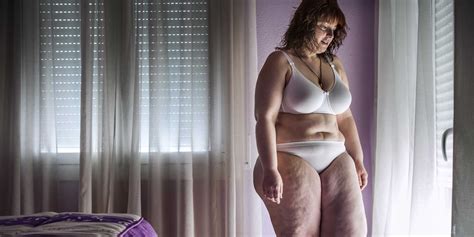 Photo Series Shows Morbidly Obese Woman S Weight Loss