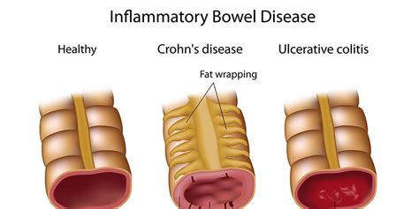 Inflammatory Bowel Disease Prevention