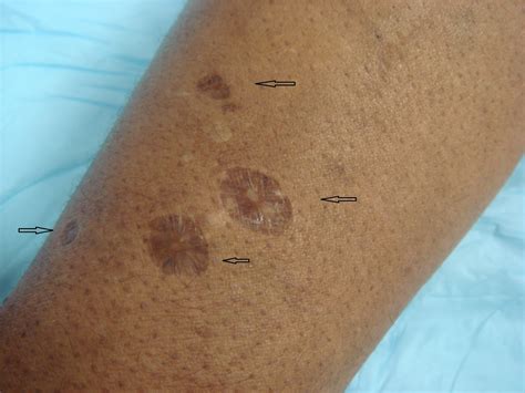recognizing skin popping scars   benefits  early intervention