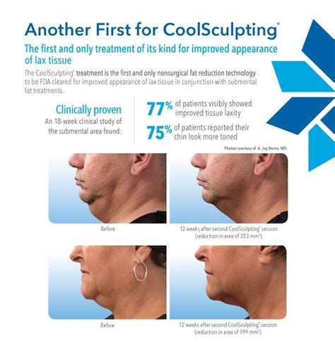 coolsculpting double chin  home windowsashbronzescrewholesonline