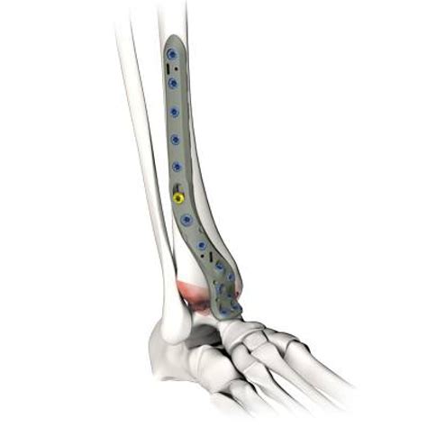 ankle arthrodesis plates