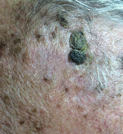 age wart  face marsden skin cancer clinic