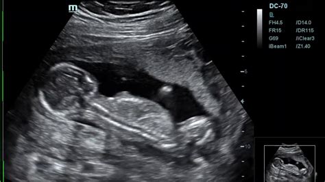 16 week gender ultrasound youtube