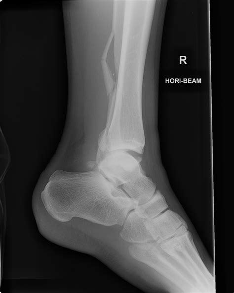 ray ankle dislocation medworldonline