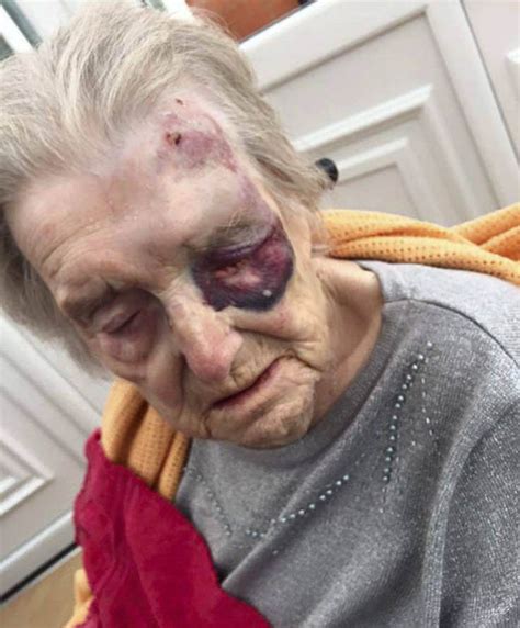 police probe into claim that an 89 year old woman was attacked by nurse