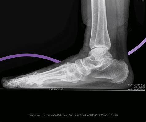 mid foot osteoarthritis  symptoms treatment  feet people