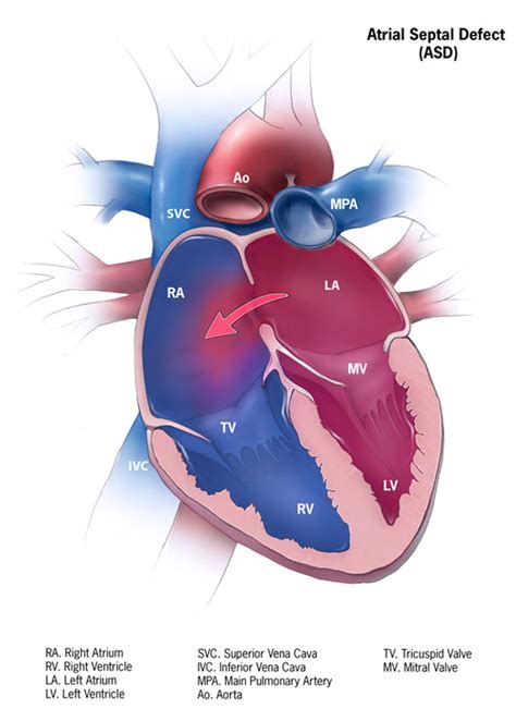 cdc congenital heart defects atrial septal defect graphic  ncbddd