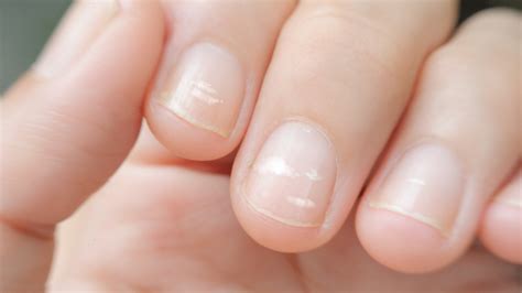white marks   fingernails  white spots