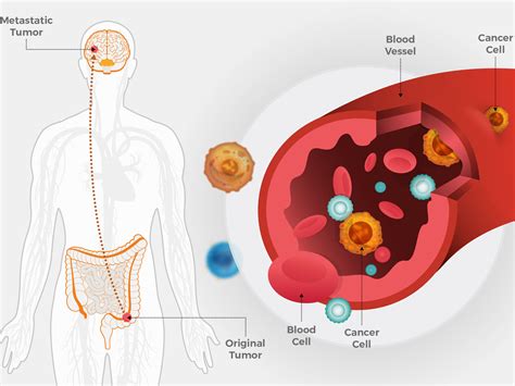 metastatic colorectal cancer  spread early nci